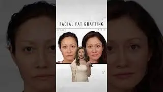 Facial Fat Grafting Results! Better than Filler #youtubeshorts #facial #facials