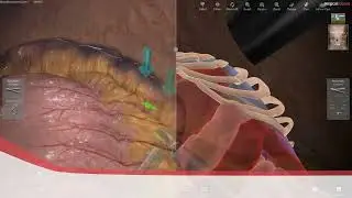 LAP Mentor  - Distal Gastrectomy