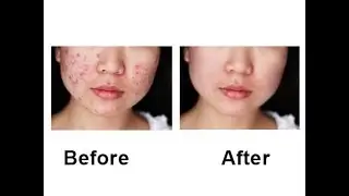 How to cut Acne in Adobe Photoshop | របៀបកាត់មុននៅក្នុងកម្មវិធី | Adobe Photoshop
