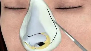 Piezo ( Ultrasonik ) Burun Estetiği 3D Animasyon - Dr. Baris Yigit