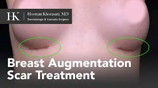 Reduce Breast Augmentation Scars: Dr. Hooman Khorasani’s Laser Treatment Demonstration