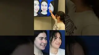 A Cute Ethnic- Middle Eastern Rhinoplasty! | Drooping Tip!