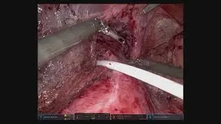 Robotic Redo Paraesophageal Hernia Repair Following a Nissen Fundoplication
