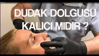 Dudak Dolgusu Kalıcı Mıdır?
