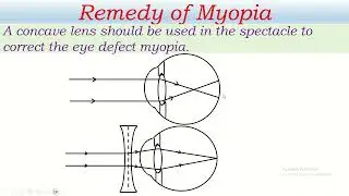 Myopia & Hypermetropia