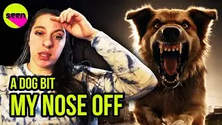 She Lost Her Nose In A Dog Attack - SEEN TV