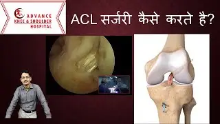 How is ACL Surgery Done (Hindi) ACL सर्जरी कैसे करते है?
