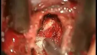 anterior cervical discectomy and left posterior lateral osteophytectomy