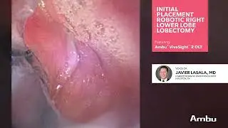 Initial Placement Robotic Right Lower Lobe Lobectomy | Dr.  Lasala Using VivaSight™ 2 DLT