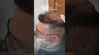 How to wash your hair after a hair transplant? - DrT Hair Transplant