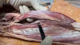 TRICEPS SURAE TENDO CALCANEUS Deep Calf Neurovascular and Clinical Aspects – Sanjoy Sanyal