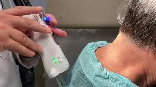 Laser Hair Removal with Leonard Bernstein, MD using the Lutronic Clarity Laser