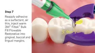 Bioclear™ Class II Restorations Video