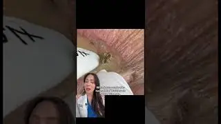 Satisfying Blackhead Extraction