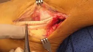 Peroneal Tendon Tear and Repair