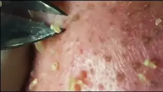 Прыщи и их удаление