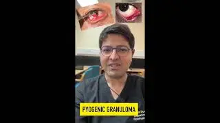 Pyogenic Granuloma - is it cancer? #shortsvideo #shorts #short