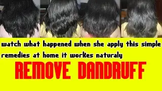 BEST home remedies to rid from dandruff forever