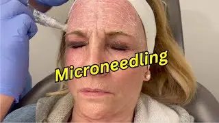 What does Microneedling look like?