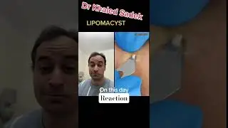 White  head! #skincare #blackheads dr khaled