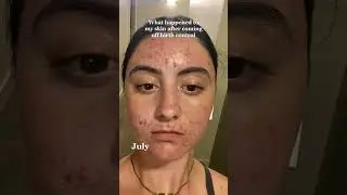 What happened to my skin after coming off of birth control 