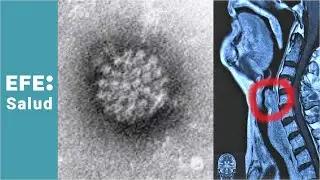 Throat cancer caused by the papillomavirus