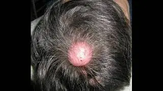 Atheroma Fatty formation Fat ball