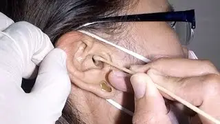 Removing Woman's Dried- Out Earwax