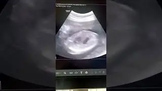 24 ҳафталик ҳомила