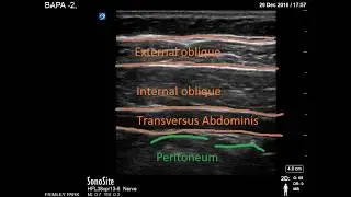 Transversus Abdominis Plane scanning