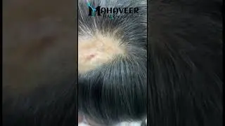 Customize Hair Patch | Hair Patch in Raipur | Best Hair Patch in India  