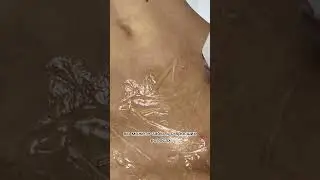 Лазерная эпиляция глубокое БИКИНИ. Наш подход! 😍