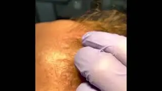 Mesoterapia Capilar. Clínica Merced 👩‍⚕️👨‍⚕️