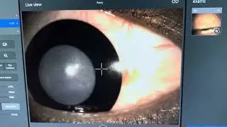 Blackened Soft Contact Lens With Clear 8mm Pupil Over Eye With Peters Anomaly