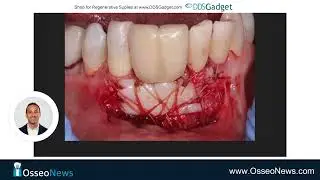 Autogenous Free Gingival Graft around Dental Implants