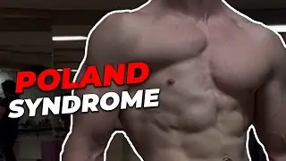 POLAND SYNDROME (my missing pec) EXPLAINED!