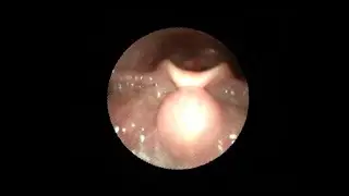 Киста корня языка у мальчика 5 лет / Base of tongue cyst in a 5-year-old boy