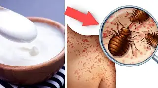 Treat Bed Bug Bites, Itch On Skin At Home - Relieve Bed Bug Bites