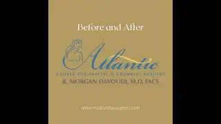 Butt Augmentation with Fat Transfer Atlanta GA | Butt Lift