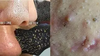 How To Remove Blackhead/Whitehead at Home Remedy|💯 Work Must Try| Priya Creations|