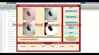 CNN Melanoma Detection Using Matlab Project With Source Code | Melanoma Skin Cancer Identification