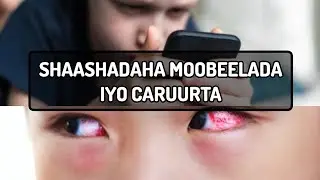 Shaashadaha Moobeelada iyo Indhaha Caruurta 👁️👀 Dr.shiine@xogocaafimaad