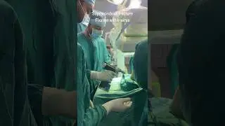 Supracondylar fracture of humerus fixed with k-wires #trauma #surgery #pediatrics #raipur