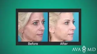 Liquid Facelift - A Non-Surgical Anti-Aging Treatment
