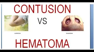 Surgery 011 Wound Contusion Hematoma Difference Vs Compare Between