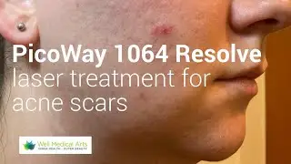 PicoWay 1064 Resolve for Acne scars Treatment #2