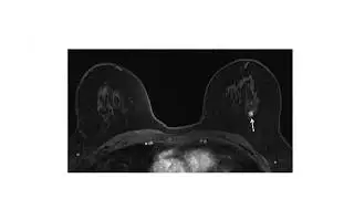 Breast MRI