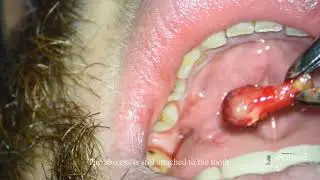 Dental abscess still attached to an infected tooth