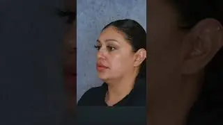 CRAZY Chin Lipo Results 🤯🎉 