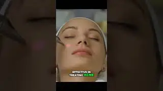 The Ultimate Guide to Treating Acne Scarring